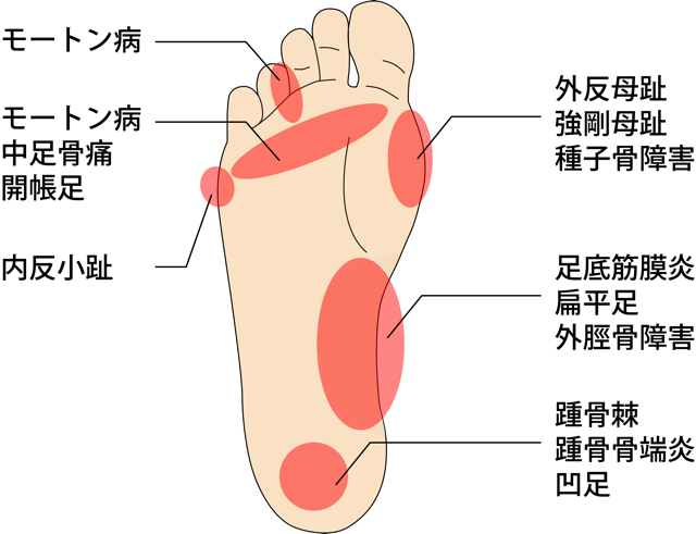 病気 かかと 痛い