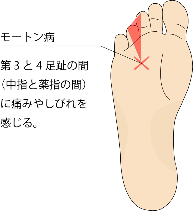 足 の 裏 刺さる よう な 痛み