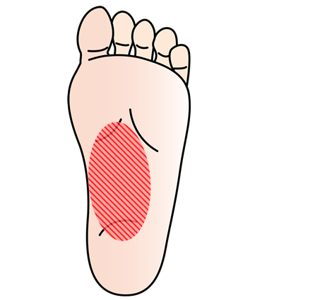 かかとが腫れているような気がするのは足底筋膜炎かもしれません 南浦和の整体 巡り整体院 口コミno 1で雑誌にも掲載