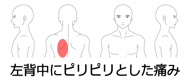 肋間神経痛の症例 帯状疱疹から背中のピリピリ感が続く 南浦和の整体 巡り整体院 口コミno 1で雑誌にも掲載