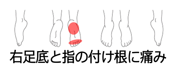 足底筋膜炎の症例 右足裏にジンジンとした痛みと違和感 南浦和の整体 巡り整体院 口コミno 1で雑誌にも掲載