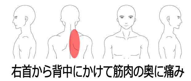 肋間神経痛の症例 首を動かすと背中に痛みが悪化する 南浦和の整体 巡り整体院 口コミno 1で雑誌にも掲載