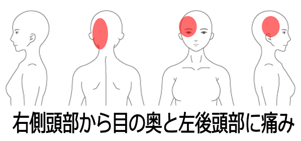 頭痛の症例 目の奥がズキズキ 頭がズーンと重いような頭痛 南浦和の整体 巡り整体院 口コミno 1で雑誌にも掲載